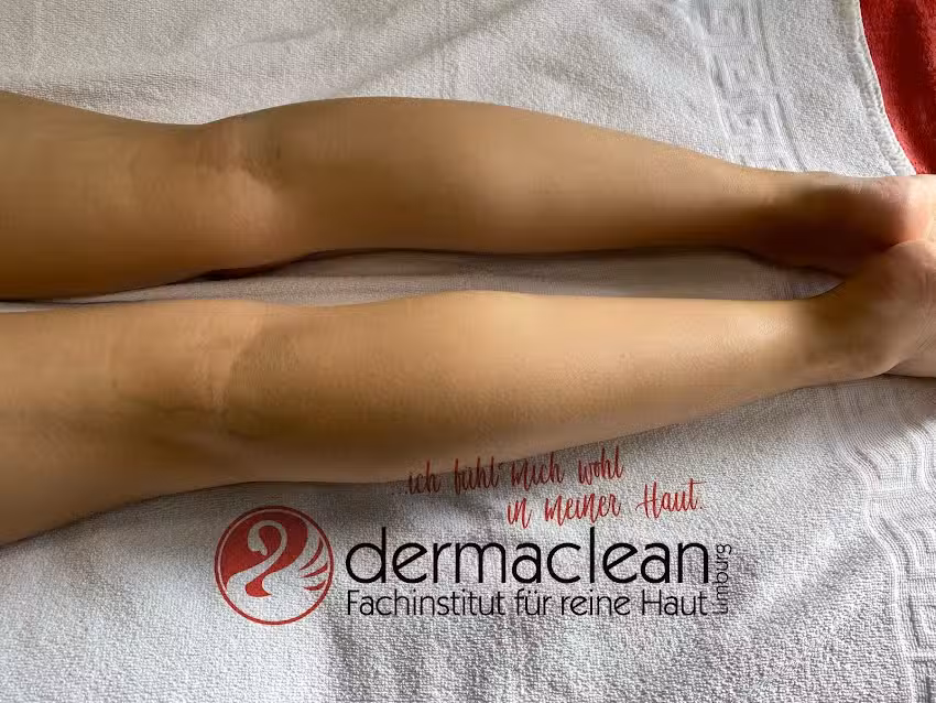Dauerhafte Haarentfernung, Dermaclean Limburg | Laser Haarentfernung, Permanent Make up, Microblading, Lidstrafung ohne op