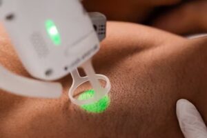 Haarentfernung Landsberg &ndash; Hairless Skin