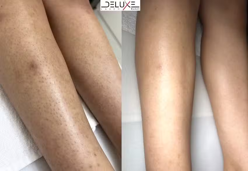 Laser Deluxe Rastatt