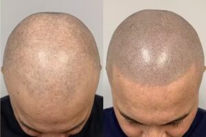 Scalp Time Haarpigmentierung